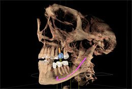 Dental Implants Scan Photo