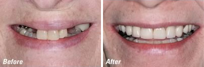 Before and After Dental Implants