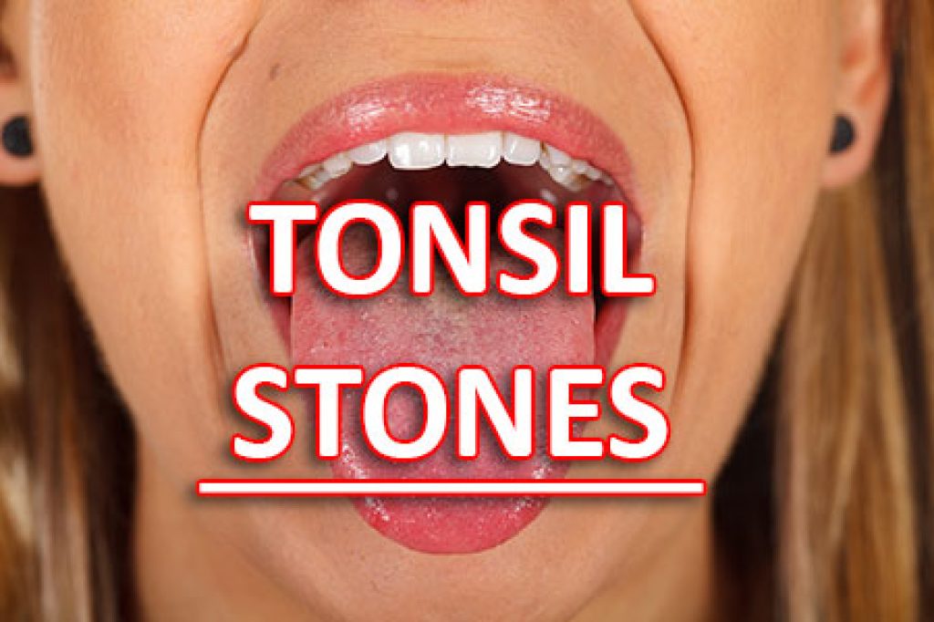 Bad throat. How to clean Tonsil Stones. Tonsil Stones in Crypts.