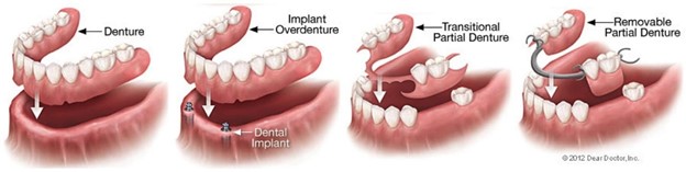 Different dentures