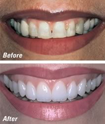 Do all veneers glow under UV lights?! #veneer #veneers